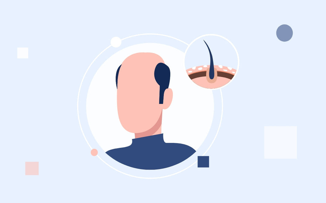 Verdades y mitos sobre la calvicie masculina