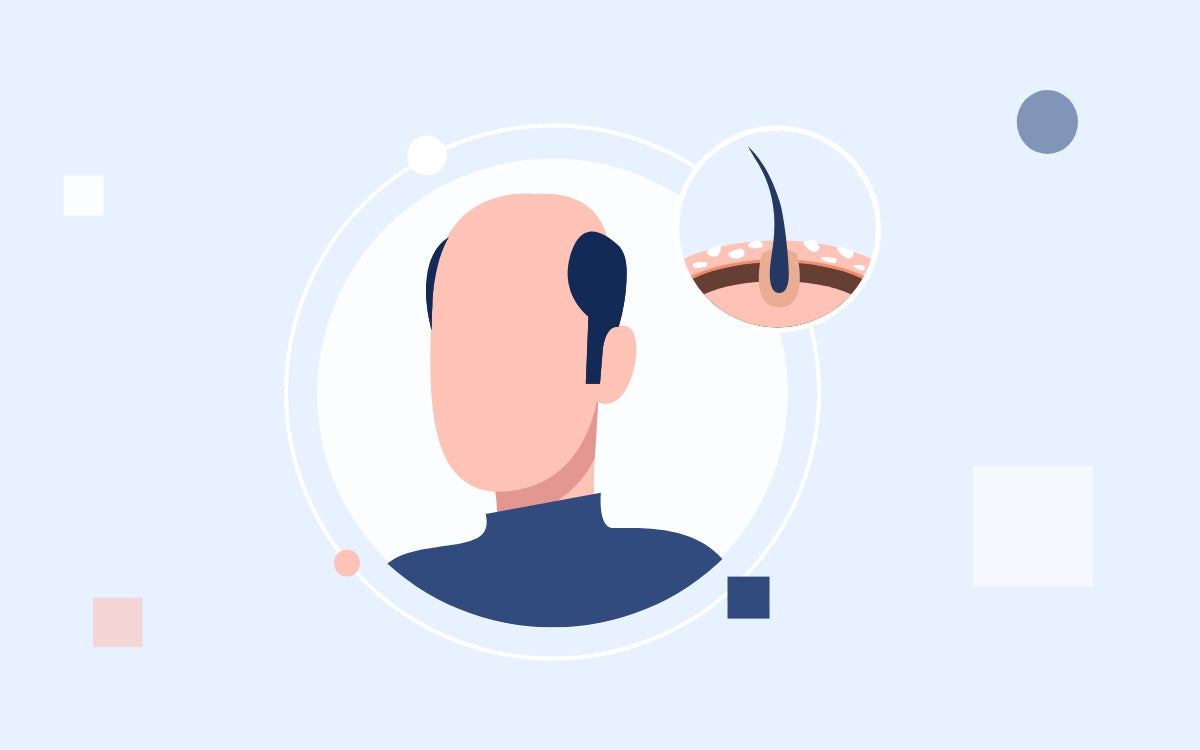 Verdades y mitos sobre la calvicie masculina