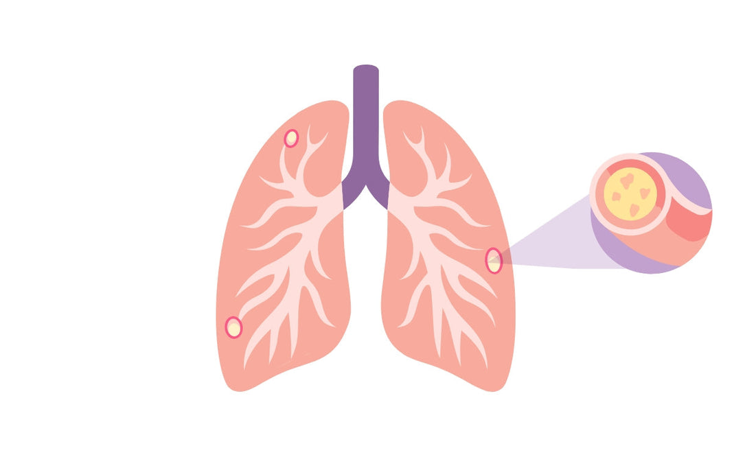 ¿La fibrosis quística es hereditaria?
