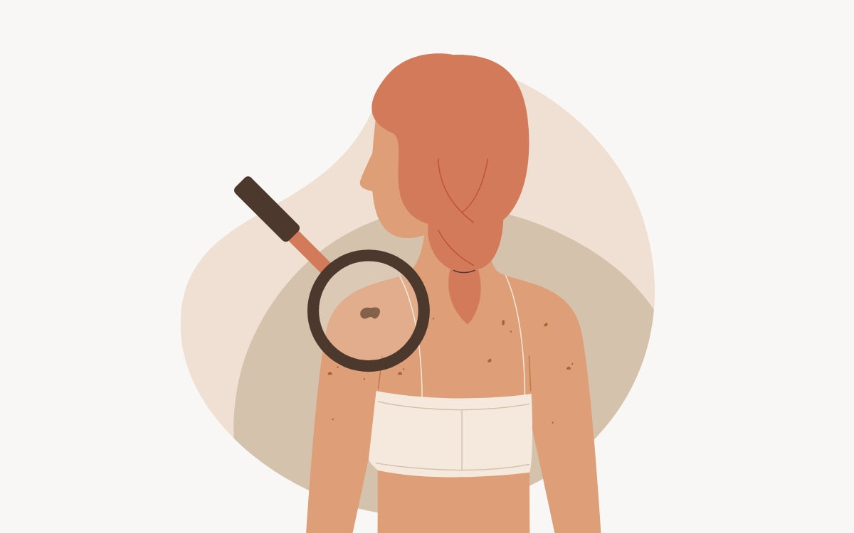 La genética en el melanoma